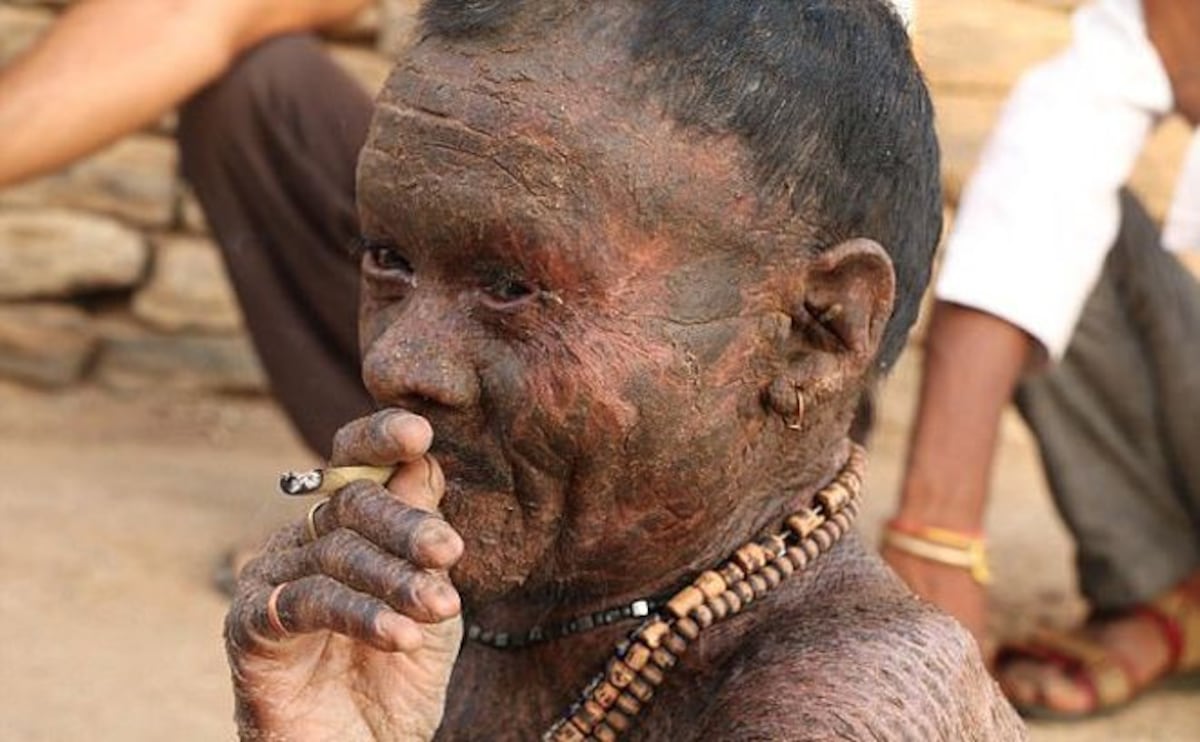 El hombre culebra cambia de piel cada 10 días (FOTOS)