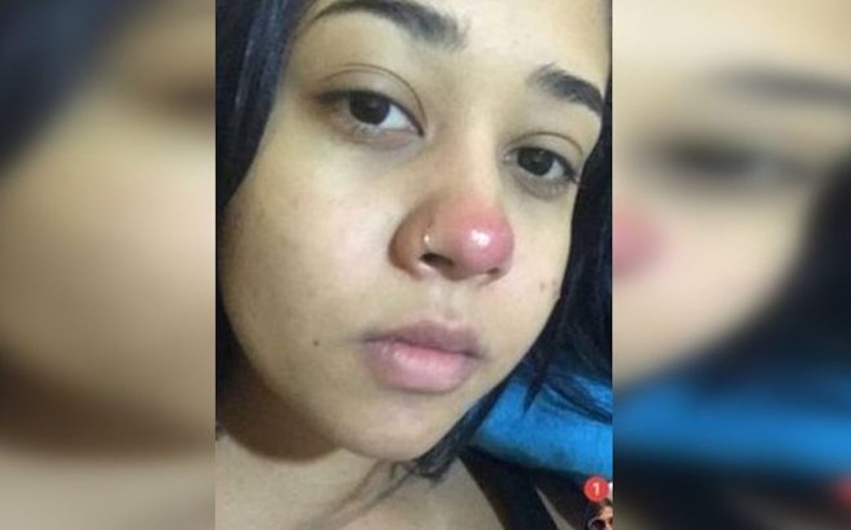 Se puso un piercing para verse 'cool' y terminó parapléjica