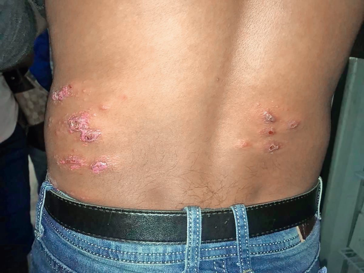 Se reporta aumento de casos de Leishmaniasis en Coclé